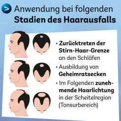 Online Dexcel Minoxidil 50 mg / ml Spray z.Anw.a.d.Kopfhaut, 3X60 ml