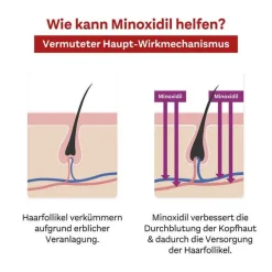 Discount MINOXIDIL 20 mg/ml Lösung für Frauen, 2x180 ml Mittel Gegen Haarausfall