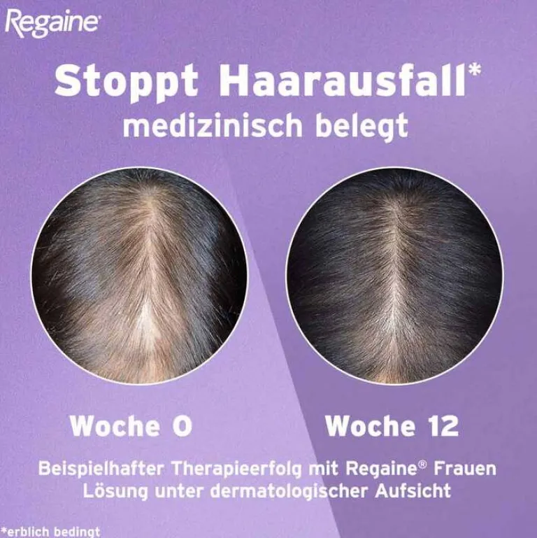 Sale Frauen Lösung, 60 ml Mittel Gegen Haarausfall