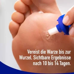 Clearance Wartner Fußwarzen Spray, 50 ml